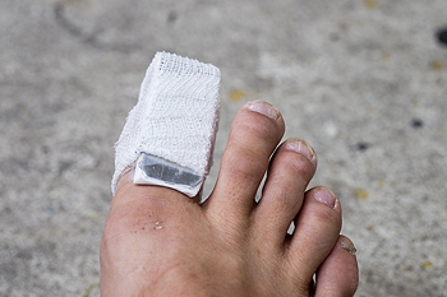 what-to-expect-if-you-have-broken-your-toe